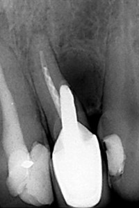 Powtórne leczenie kanałowe górnej dwójki połaczone z usunięciem z kanału sztyftu oraz zamknięciem perforacji. Kontrola: niemal całkowicie wygojony stan zapalny korzenia zęba.