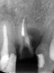 Powtórne leczenie kanałowe górnej dwójki połaczone z usunięciem z kanału sztyftu oraz zamknięciem perforacji. Kontrola: niemal całkowicie wygojony stan zapalny korzenia zęba.