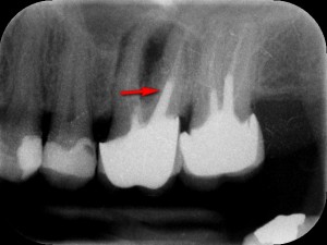Powtórne leczenie kanałowe górnej szóstki i siódemki połączone z usunięciem z korzeni zębów sztyftów oraz zamknięciem perforacji (czerwona strzałka).