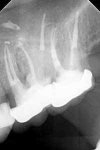 Powtórne leczenie kanałowe górnej szóstki i siódemki połączone z usunięciem z korzeni zębów sztyftów oraz zamknięciem perforacji (czerwona strzałka).