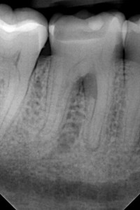 Leczenie kanałowe dolnej szóstki. Rzadko spotykana pięciokanałowa anatomia zęba.