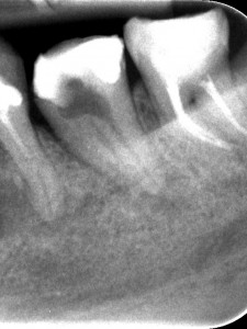 Kontynuacja leczenia kanałowego dolnej siódemki rozpoczętego poza gabinetem. Nietypowa anatomia zęba typu C-shape była przyczyną perforacji oraz niemooności odnalezienia ujść kanałów.