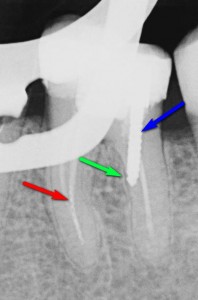Powtórne leczenie kanałowe dolnej szóstki połączone z usunięciem z zęba sztyftu (niebieska strzałka), zamknięciem perforacji (zielona strzałka) oraz usunięciem złamanego narzędzia (czerwona strzałka).