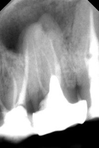 Leczenie kanałowe górnej siódemki połączone z usunięciem z wnętrza zęba sztyftu.