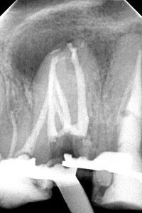 Leczenie kanałowe górnej siódemki połączone z usunięciem z wnętrza zęba sztyftu.