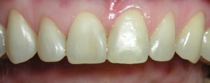 Wybielanie i korekta kształtu zębów kompozytem.