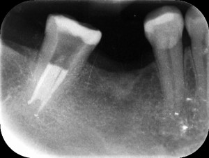 Leczenie kanałowe dolnej siódemki - kanały w rzadko spotykanym układzie C-shape (3-5% zębów u osób rasy białej).