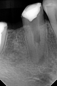 Kontynuacja leczenia kanałowego dolnej czwórki - niezwykle rzadka anatomia zęba typu C-shape. System kanałowy ma kształt zbliżony do litery C.