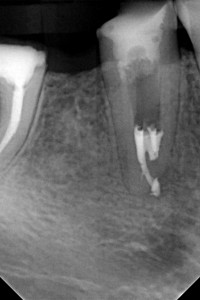 Kontynuacja leczenia kanałowego dolnej czwórki - niezwykle rzadka anatomia zęba typu C-shape. System kanałowy ma kształt zbliżony do litery C.