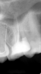 Powtórne leczenie kanałowe górnej szóstki - po starannym opracowaniu systemu kanałowego ostatecznie ząb miał najczęściej spotykaną formę czterokanałową. Część kanałów (pierwotnie 6) połączyła się w jedną całość.