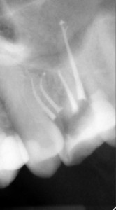 Powtórne leczenie kanałowe górnej szóstki - po starannym opracowaniu systemu kanałowego ostatecznie ząb miał najczęściej spotykaną formę czterokanałową. Część kanałów (pierwotnie 6) połączyła się w jedną całość.