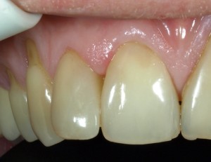 Zmiana kształtu zębów i wymiana wypełnień kompozytowych.