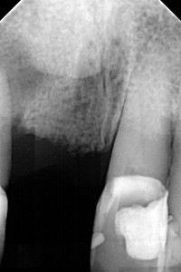 Leczenie kanałowe górnej jedynki. Długotrwałe i intensywne oczyszczanie wnętrza zęba pozwoliło wypełnić nie tylko kanał główny, ale również liczne kanały boczne.