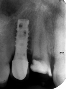 Leczenie kanałowe górnej czwórki. Rzadko spotykana trzykanałowa forma zęba.