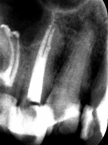 Leczenie kanałowe górnej czwórki. Bardzo rzadko spotykana trzykanałowa forma zęba z głębokim miejscem odgałęzienia trzeciego kanałuu (zielona strzałka).