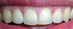 Zamknięcie szpar oraz poprawa kształtu zębów kompozytem.