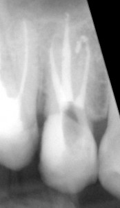 Powtórne leczenie kanałowe górnej piątki. Bardzo rzadka anatomicznie forma zęba z trzema kanałami (ok. 1% przypadków).
