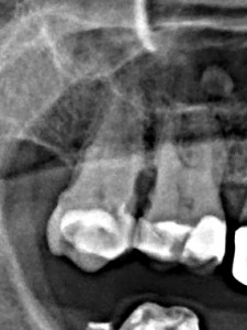 Leczenie kanałowe górnej siódemki. Rzadziej spotykana czterokanałowa anatomia zęba z nietypowym przebiegiem łaczących się ze sobą kanałów.