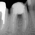 Wnętrze zęba 37 w momencie rozpoczęcia leczenia pod mikroskopem