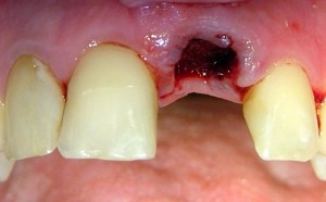 Zębodół bezpośrednio po usunięciu zęba 21.