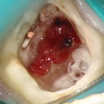 Ząb 37: stan po wypełnieniu kanałów i zamknięciu perforacji