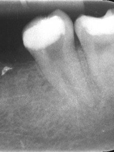 RTG zęba 37 przed leczeniem