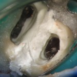 Wytrawienie szkliwa zębów filarowych 36% kwasem ortofosforowym.