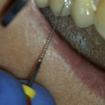 RTG zęba 47 przed leczeniem