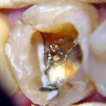 Dotychczasowe wypełnienia w leczonym zębie 36 okazały się całkowicie nieszczelne i otoczone zniszczoną próchnicowo zębiną.