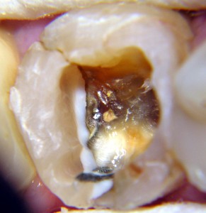 Dotychczasowe wypełnienia w leczonym zębie 36 okazały się całkowicie nieszczelne i otoczone zniszczoną próchnicowo zębiną.