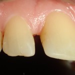 Estetyka górnych zębów pozostawia dużo do życzenia – wychylone siekacze centralne, tremy, matowe i zużyte wypełnienia.