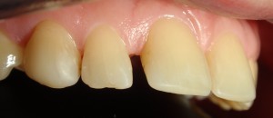 Estetyka górnych zębów pozostawia dużo do życzenia – wychylone siekacze centralne, tremy, matowe i zużyte wypełnienia.