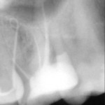 RTG zęba 26 przed leczeniem. W świetle przetoki tkwi zawinięty ćwiek gutaperkowy.