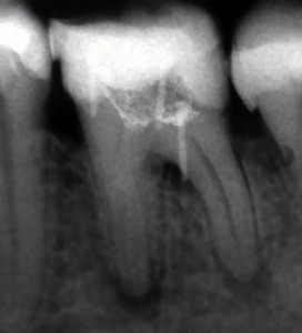 Rtg zęba 36 przed leczeniem.