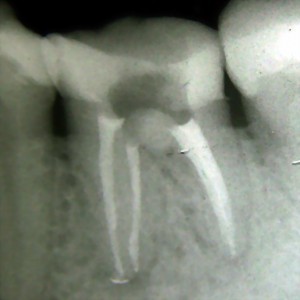 Rtg zęba 36 po wstępnej odbudowie i przeprowadzonym leczeniu endodontycznym.