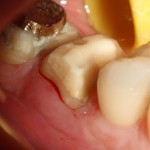 RTG zęba 37: widoczna nadmierna preparacja w poszukiwaniu kanałów mezjalnych