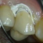 RTG zęba po wypełnieniu kanałów: oddzielny kanał ML oraz łączące się cieśnią ML i D z osobnymi otworami wierzchołkowymi
